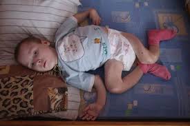 The chernobyl rbmk reactor design faults and how they were addressed. Birth Defects Related To Chernobyl