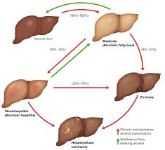 Check spelling or type a new query. Alcoholic Liver Disease Concise Medical Knowledge