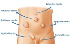 Hernia – Causes, Types, Diagnosis & Advanced Treatment | Wockhardt Hospitals