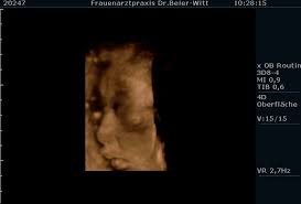Ultraschall 20.ssw (19+3) junge, outing, its a boy, sonographie, pregnant, baby, schwanger. 3d 4d Ultraschall Dr Med Angelika Beier Witt