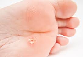 Clean it up in the morning. How To Treat Corns Calluses At Home 13 Easy Home Remedies