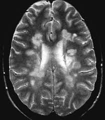 Multiple sclerosis (ms) is a condition that can affect the brain and spinal cord, causing a wide range of potential symptoms, including problems with vision, arm or leg movement, sensation or balance. Sinc
