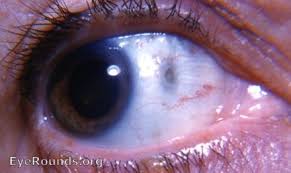 Image result for lesion sclera