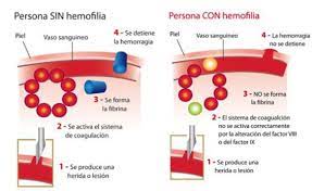 This results in people bleeding for a longer time after an injury, easy bruising, and an increased risk of bleeding inside joints or the brain. Pin On Coagulopatias
