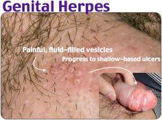 Tinea corporis is a superficial dermatophyte infection characterized by either inflammatory or noninflammatory lesions on the glabrous skin (ie, skin regions except the scalp, groin, palms, and. 73 Boli Dermatologice Ideas SÄƒnÄƒtate Diete Detoxifiere Tratamente Pentru Piele