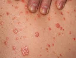 Learn how to differentiate scalp psoriasis from dandruff, and how to treat scalp psoriasis effec. Treatment Of Psoriasis Dermnet Nz