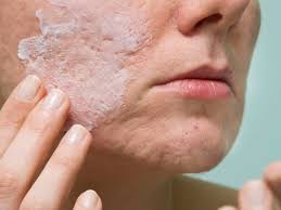 This medication is also used to help remove corns and salicylic acid penetrates into your skin and works to dissolve the dead skin cells clogging your pores. Salicylic Acid For Acne Efficacy How To Use And More