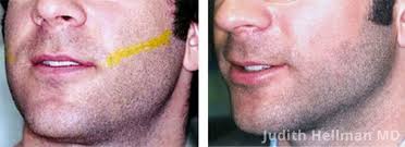 Consistency of treatment and efficiency of our professionals at hairless nyc electrolysis clinic ensure. Laser Hair Removal Nyc Permanent Hair Removal New York