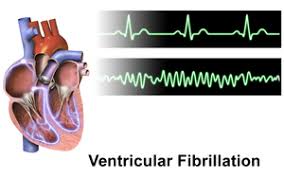 Image result for Ventricular Fibrillation Management in the Adult