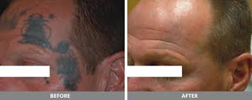 At laser tattoo removal seattle we offer the most advanced tattoo removal techniques to give you better results in fewer visits. Laser Tattoo Removal Kucumber
