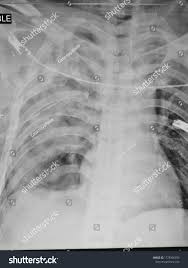 Image result for Flail Chest