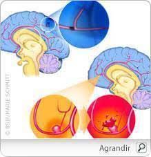 L'anévrisme cérébral correspond à une dilatation d'une artère cérébrale. Avc Quels Sont Les Signes D Un Accident Vasculaire Cerebral
