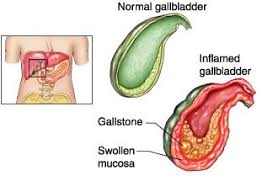 Acute Cholecystitis Thinglink Medical Surgical Nursing Gallbladder Liver Health