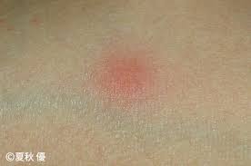 Jun 17, 2021 · あなたを狙う「有毒」動物 「蚊アレルギー」強い皮膚症状の原因はebウイルスにあり. è™«ã•ã•ã‚Œãƒã‚§ãƒƒã‚¯ æ±äº¬2020 ã‚¢ãƒ¼ã‚¹è£½è–¬