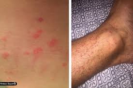 Tahta Kurusu Bed Bug Ve Keneden Korunma Yontemleri Rotasiz Seyyah