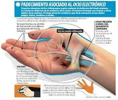 Neurocirugia Leon Dolor En La Muneca Y Adormecimiento En Los Dedos De La Mano Estos Sintomas Pueden Ser Originados Por Una Compresion Del Nervio Mediano Dentro De Los Ligamentos De La