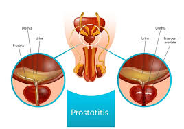 Image result for Prostatitis General Measures