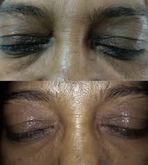 Here dr rajani demonstrates prf injected with a microcannula under the eye as his first step in rejuvenating the eye region. Injectable Platelet Rich Fibrin Prf The Newest Biomaterial And Its Use In Various Dermatological Conditions In Our Practice A Case Series Shashank 2021 Journal Of Cosmetic Dermatology Wiley Online Library