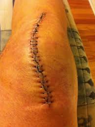 A scar recovery photo gallery. Madison Healthcare Acl Surgery Scar