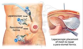 Pain could happen if the cancer grows into or destroys nearby tissue. Are You Ignoring The Symptoms Of A Hernia Cchc