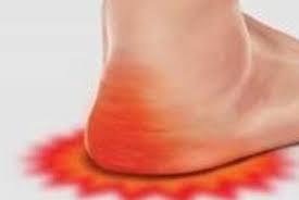 ما هو مرض النقرس تعرف على مرض النقرس احبك موت