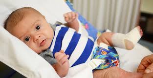 Clubfoot is about twice as common in boys and occurs in both feet about 50% of the time. Babies And Clubfoot