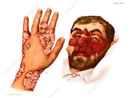 Tuberculosis cutis — localización de la tuberculosis en la piel; Cutaneous Tuberculosis Illustration Stock Image C030 8489 Science Photo Library