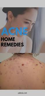 Read More About Acne Simply Click Here For More Back Acne Treatment Face Acne Acne Treatment