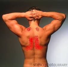 Det kan føre til både ømme. Muskelknuter I Ryggen Helse Diskusjon No