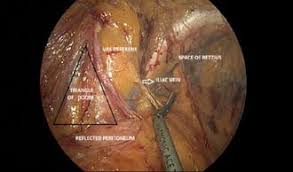 Related online courses on physioplus. Inguinal Anatomy With Peritoneum Incised Laparoscopic Hernia Surgery