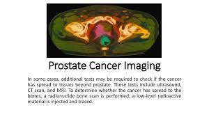 Prostate cancer can sometimes spread from the prostate to the bones, which is known as bone metastasis. What Is Prostate Cancer Ppt Download