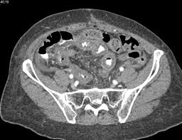 Image result for Radiation Colitis