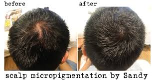 Pin On Scalp Micropigmentation