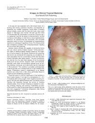 Image result for Scombroid Fish Poisoning