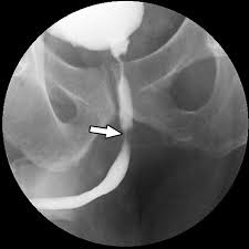 Image result for Retrograde Urethrogram