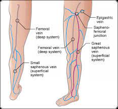 Pin On Varicose Veins Remedies