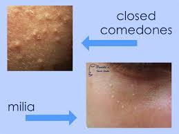 Closed comedones, or whiteheads, are small bumps that usually develop in areas where pores are largest and most densely concentrated such as the face pustules are inflammatory acne lesions that are typically larger than closed comedones. The Acne Whisperer Adult Acne In The Presence Of Dehydration Part 2