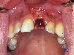 Image result for Tooth Avulsion