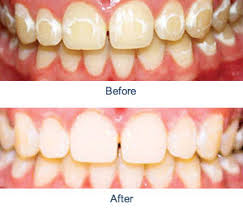 If you want to prevent white spots on your teeth when your braces come off, start by brushing after every meal the entire time you are wearing braces in order to avoid plaque. How To Get Rid Of White Spots On Teeth From Braces Teethwalls