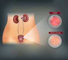 Il est plus efficace si vous le prenez d&egrave;s que possible apr&egrave;s un rapport sexuel non prot&eacute;g&eacute;. Cystite Apres Un Rapport Sexuel Que Faire