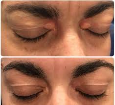 Obat Xanthelasma Di Apotik Obat Alami Kesehatan Tubuh Manusia