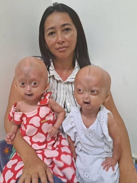 Mãe de gêmeas com velhice precoce luta pela vida das filhas em RR