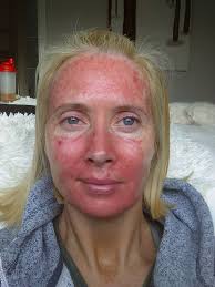 One week of healing I'd never wish...