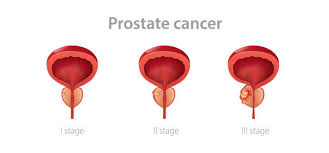 Image result for Radical Prostatectomy