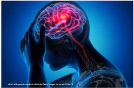 Image result for Posterior Circulation