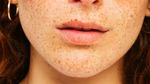 Are Freckles On Lips A Cause For Concern? Causes, Remedies