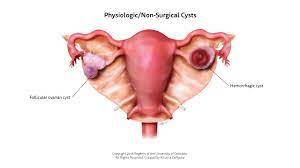 Usually we don't know what makes a cyst. Ovarian Cysts In Girls Children S Hospital Colorado