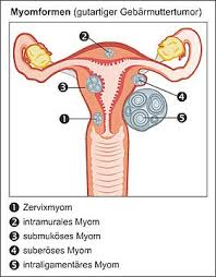 Lebensjahr uterusmyome (englisch fibroids) auf, etwa 25 prozent von ihnen haben beschwerden. Myome Gutartige Tumore Der Muskelschicht Der Gebarmutter Myome Therapie Wechseljahre