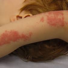Image result for Skin Infection