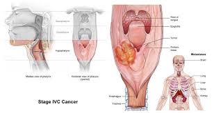 Hypopharynx Ivc Jpg 750 399 Cancer Stages Throat Cancer Cancer